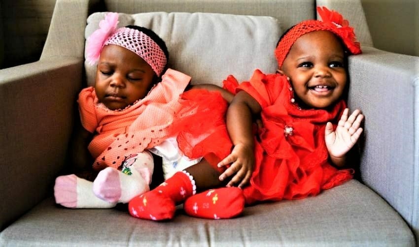 نجاح عملية فصل التوأم السيامي الكاميروني في تركيا 2021