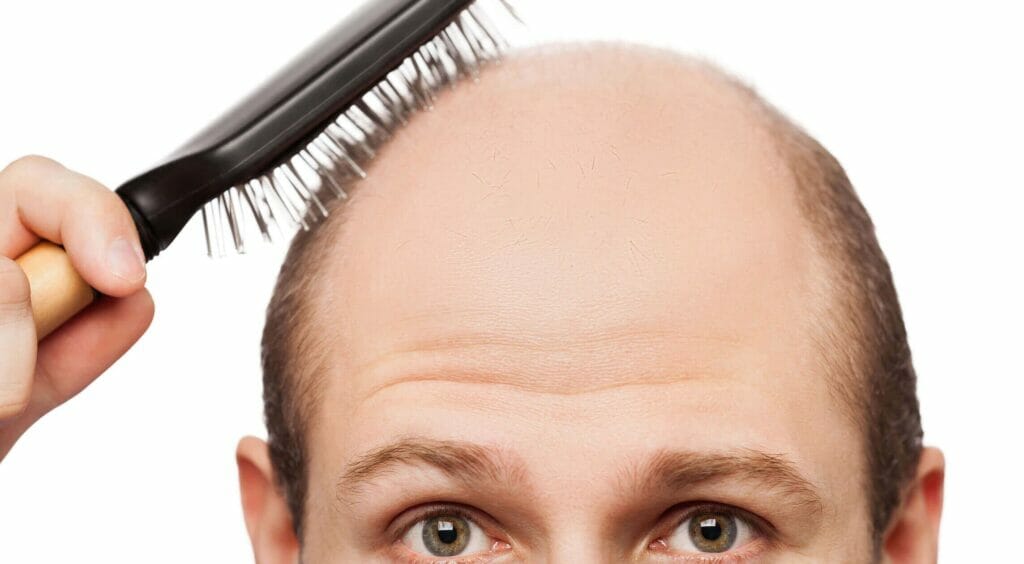 زراعة الشعر في تركيا