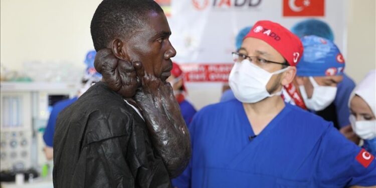 جمعية أصدقاء كل إفريقيا التركية تعالج أوغندي من كتلة ضخمة في وجهه